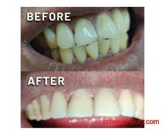 Looking for Dental Implants in Barasat? Get Full Mouth Reconstruction Arch Treatment at Ivory32