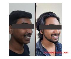 Looking for Dental Implants in Barasat? Get Full Mouth Reconstruction Arch Treatment at Ivory32