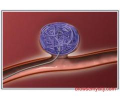 Coil Embolization Procedure: Advanced Care for Vascular Conditions