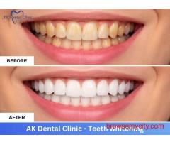Advanced Dental Teeth Whitening in Mumbai | AK Dental Clinic