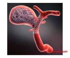 Coiling Surgery for Effective and Minimally Invasive Aneurysm Treatment