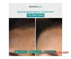 Hyperpigmentation Treatment for Dark Skin