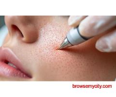 Boost Your Confidence with Microneedling Surrey – Book Now