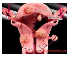 UFE Cost in Chandigarh – Get Affordable & Advanced Fibroid Treatment | IRFacilities