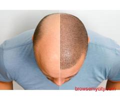 Hair Transplant in Varanasi – Trusted Hair Restoration Clinic | Hair Aesthetica