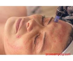 Microneedling Surrey BC – Refresh & Renew Your Skin