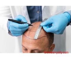 Hair Transplant in Varanasi: What Should You Know Before Treatment?
