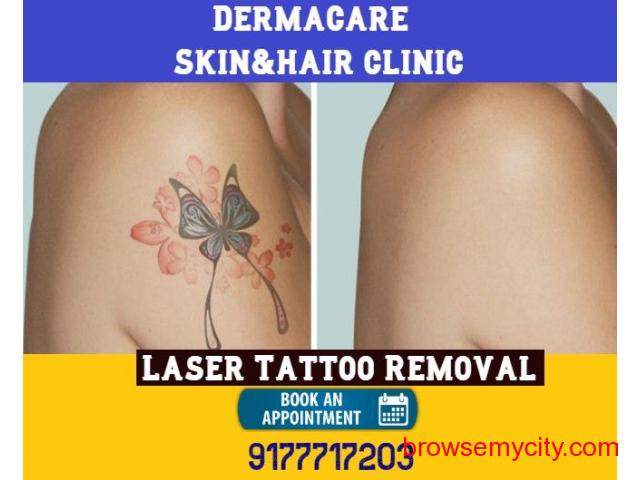 Laser tattoo removal Kolkata, Siliguri, Malda .No side-effects.painless. -  YouTube